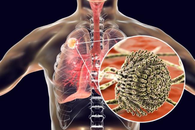 הדמיה של ריאות נגועות בפטריית אספרגילוס, קספופונגין