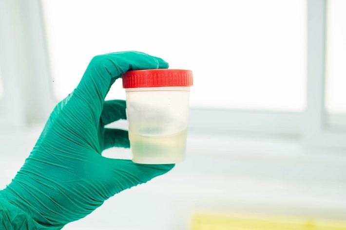 יד עם כפפת לטקס אוחזת בכלי שתן לצורך בדיקת שחפת בשתן 