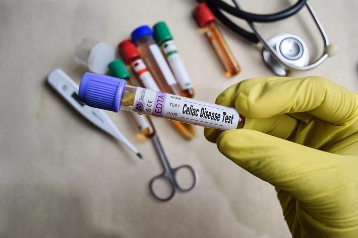 יד אוחזת במבחנה של בדיקת צליאק, בדיקת ANTI TTG IGA (נוגדנים לטרנסגלוטאמינאז)