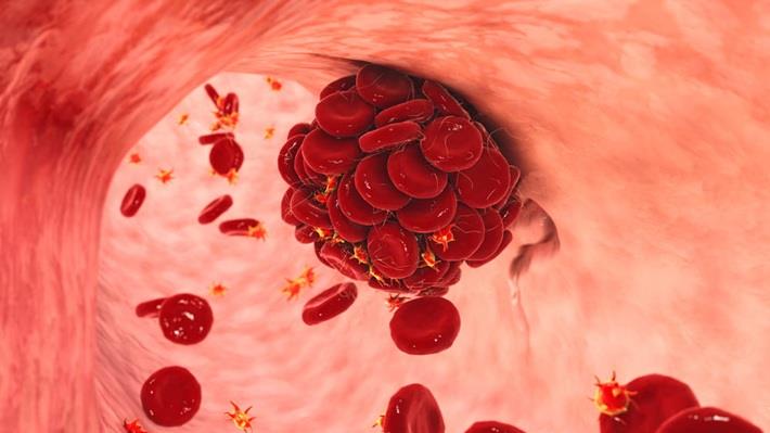 קרישת דם במסגרת בדיקת נוגדנים לקרדיוליפין CARDIOLIPIN IgG IgM