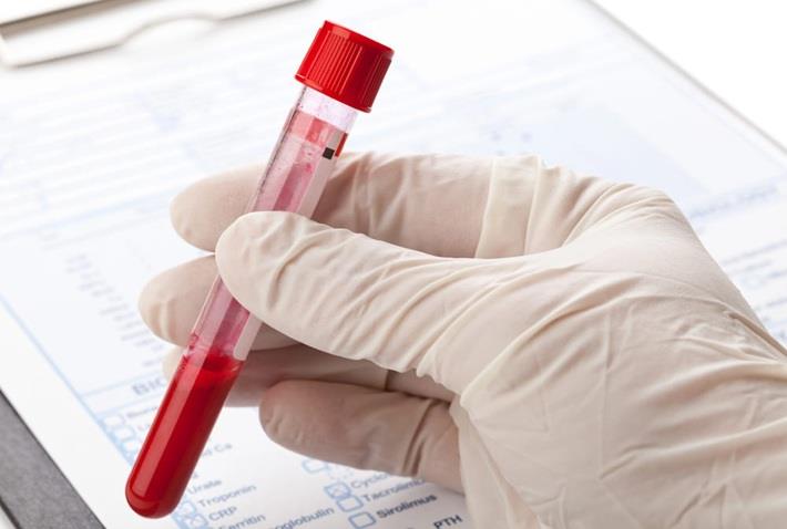 יד אוחזת במבחנה של בדיקת פרופיל וסקוליטיס Vasculitis Profile