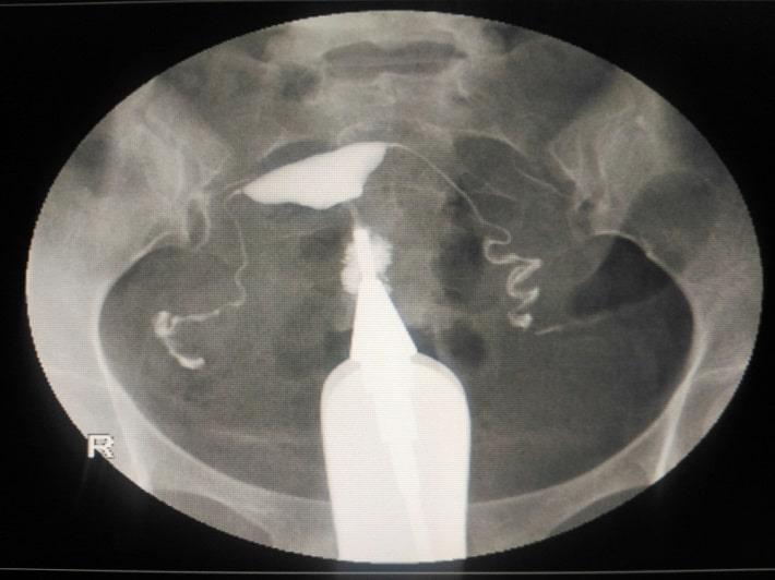 צילום רחם בו נראה הזרקת חומר הניגוד לתוך הרחם והחצוצרות