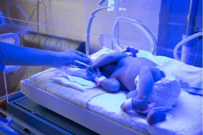 פג באינקובטור מטופל בפוטותרפיה לפני בדיקה בילירובין נאו-נטאלי