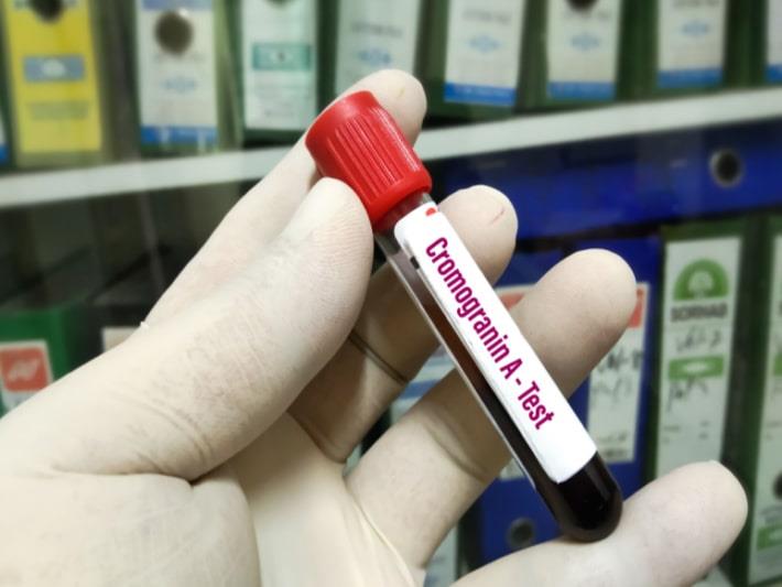 יד מחזיקה במבחנה של בדיקת כרומוגרנין A בדם 