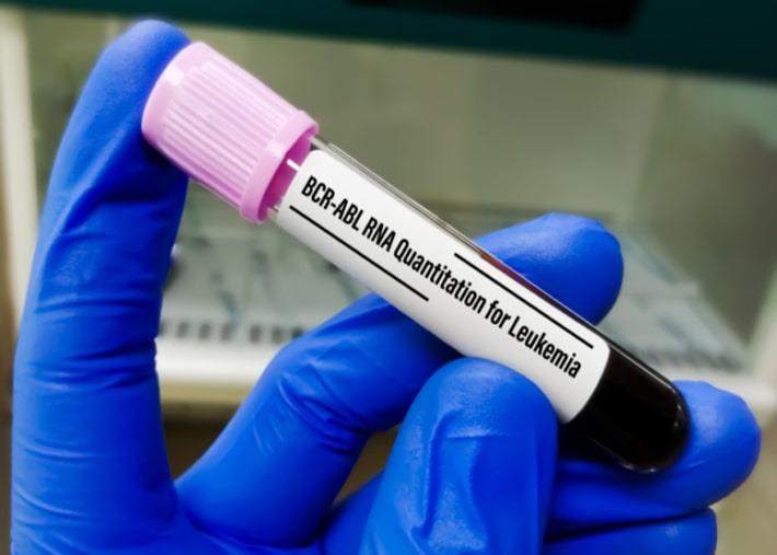 מבחנה עם בדיקת לוקמיה מיאלואידית כרונית BCR-ABL 