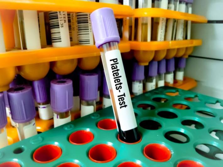 מבחנה לאחר בדיקת מבחני תפקוד טסיות דם PLATELET AGG 