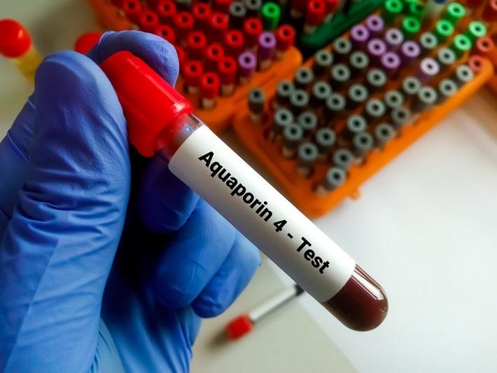 מבנה עם דם של בדיקת נוגדנים לאקוופורין 4 