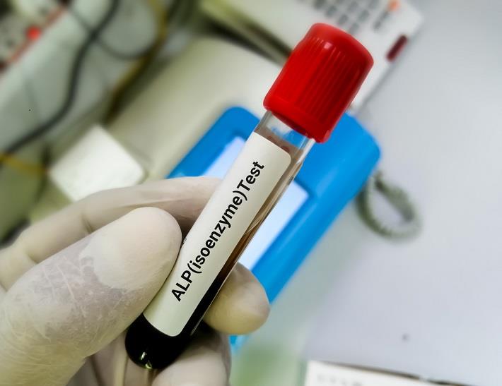 יד אוחזת במבחנה עם דם של בדיקת איזואנזימים של פוספטזה בסיסית 