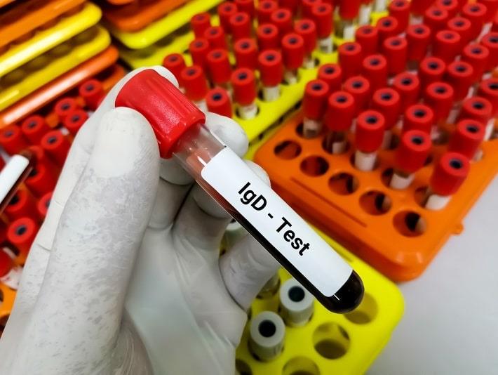 יד אוחזת במבחנה עם דם של בדיקת אימונוגלובולין D