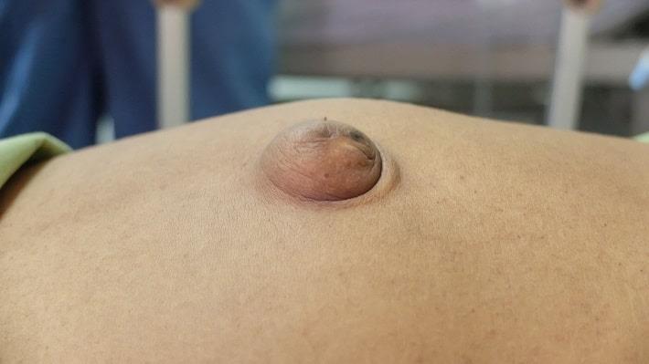 בקע טבורי על שולחן הניתוחים לפני ניתוח הרניה