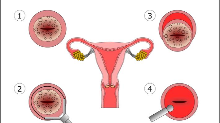 איור שמתאר קוניזציה