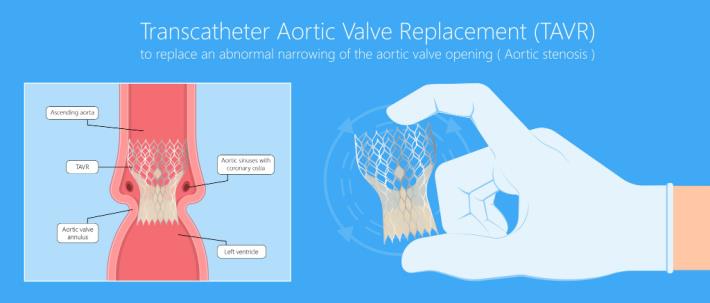 איור המדגים החלפת מסתם אאורטלי בצנתור