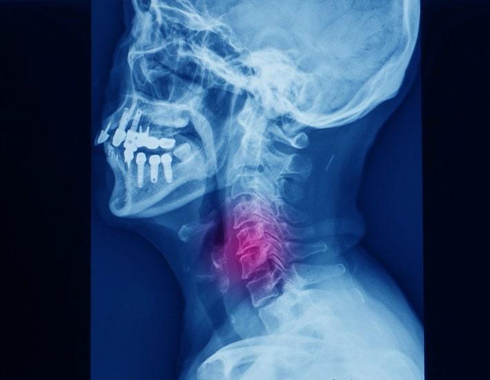 צילום רנטגן של עמוד השדרה הצווארי עם רדיקולופתיה צווארית