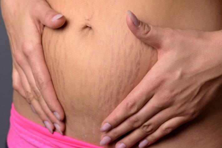 אישה אוחזת בבטנה עם סימני מתיחה לאחר היריון 
