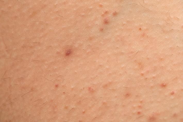 צילום תקריב של עור אדם עם פוליקוליטיס