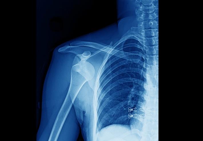 צילום רנטגן של פריקת כתף, נקע בכתף, פריקה בכתף