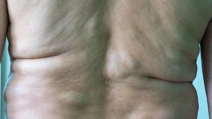 גב של איש שמן עם ליפומות