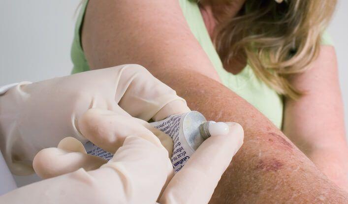 מריחת סינטומיצין על זרוע של אישה עם זיהום בעור