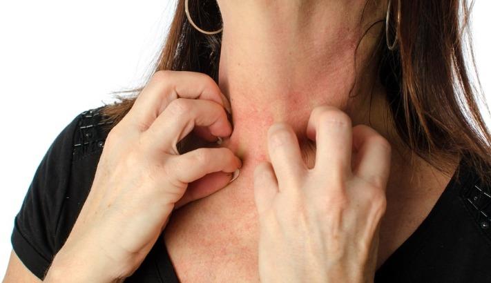 אישה סובלת מאלרגיה בעור, מגרדת את אזור הצוואר, פרומתאזין 