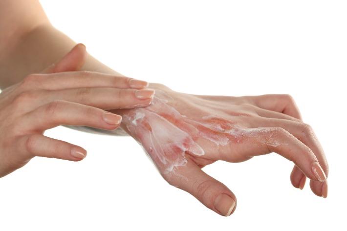 אישה מורחת על ידה קרם המכיל טרולאמין הנועד לטיפול בכוויות שטחיות 