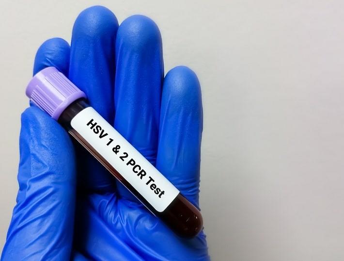 יד עם כפפת לטקס כחולה אוחזת במבחנת דם של בדיקת PCR להרפס סימפלקס ווריצלה זוסטר 