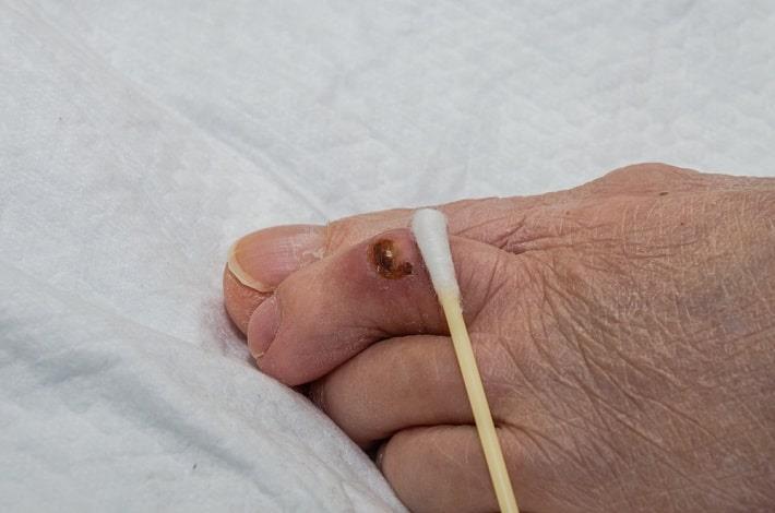 תקריב של לקיחת דגימה מפצע ברגל באמצעות מטוש, בדיקת שחפת בפצע