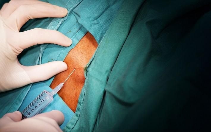 יד של כירורגית מבצעת בדיקת ביופסיה עם מחט על עור של מטופל