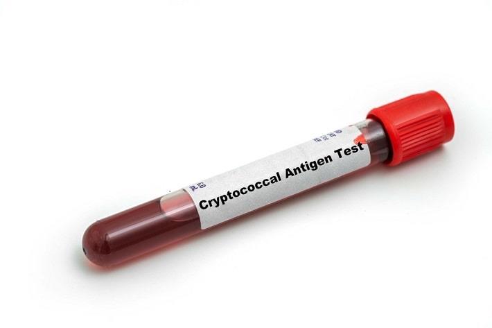 מבחנה עם דם של בדיקת אנטיגן של קריפטוקוקוס