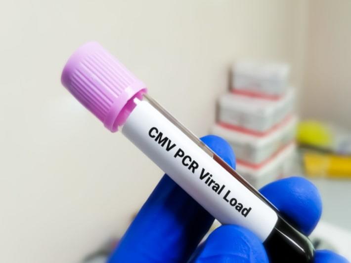 יד אוחזת במבחנה של בדיקת PCR לאיתור זיהום בנגיף ציטומגלו CMV