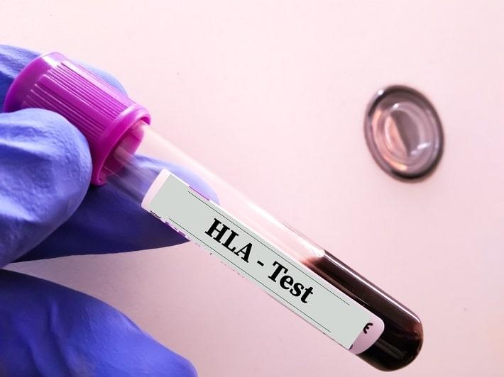 מבחנה של בדיקת אנטיגנים לויקוציטיים אנושיים HLA-B5