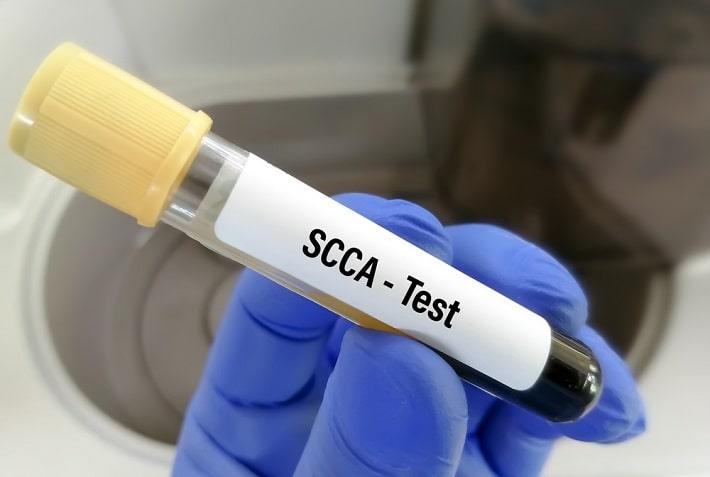 יד אוחזת במבחנה של בדיקת קרצינומת תאי קשקש SCCA