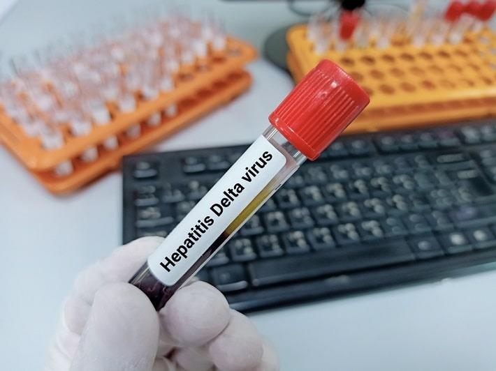 יד מחזיקה מבחנת דם של בדיקת נוגדנים להפטיטיס D על רקע מבחנות במעבדה
