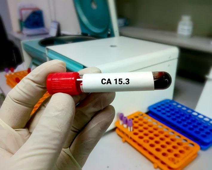 יד אוחזת במבחנה עם דם לצורך בדיקת סמן סרטני CA-15-3