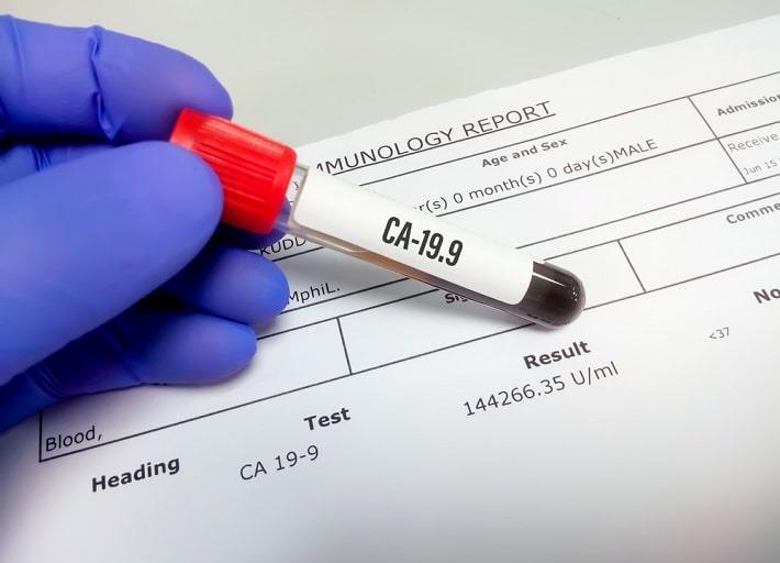 יד אוחזת במבחנה עם דם לאחר ביצוע בדיקת סמן סרטני CA-19-9