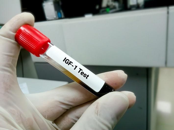 יד אוחזת במבחנה עם דם של בדיקת גורם גדילה דמוי-אינסולין 1, IGF-1