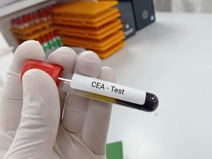 יד אוחזת במבחנה עם דם בדיקת אנטיגן קרצינואמבריוני CEA 