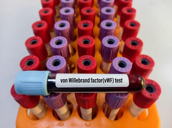 מבחנה עם דם של בדיקת אנטיגן וון-ווילברנד  על רקע מבחנות נוספות