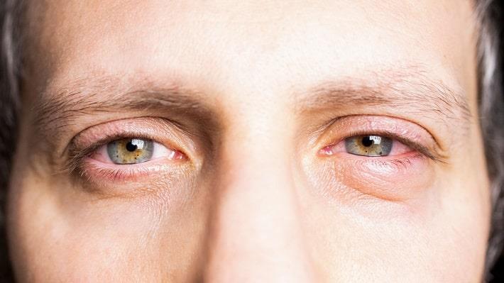 קלוז אפ של עיניים מגורות של גבר בעקבות חשיפה לחומצה טריכלורואצטית