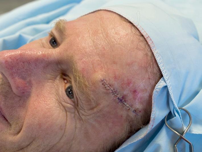 איש שוכב לאחר ניתוח מוז באזור הפנים