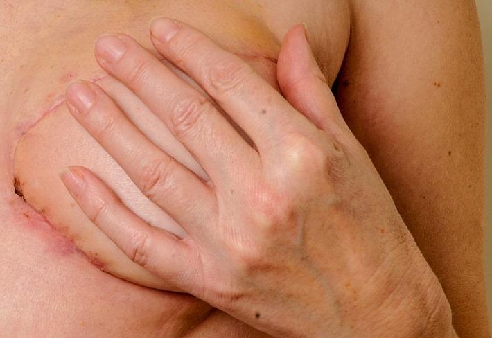 אישה אוחזת בשד החדש שלה לאחר ניתוח שחזור שד