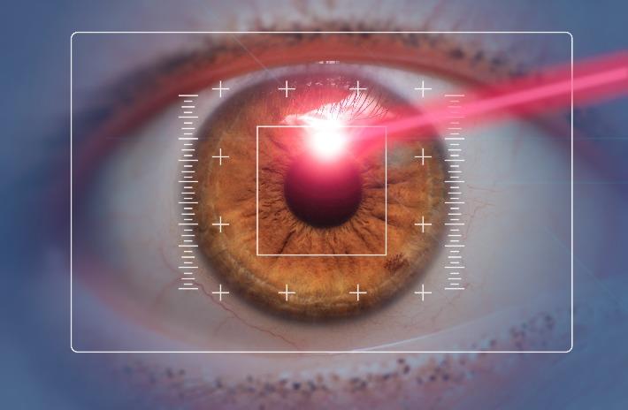 קרן לייזר נשלחת לתוך העין בזמן ניתוח הסרת משקפיים בלייזר
