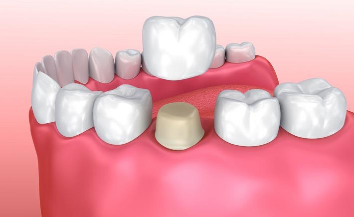 דגם של שיניים עם שן אחת שעליה יש מורכב כתר בשן