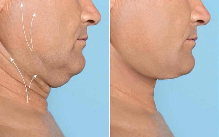 פרופיל פנים של גבר לפני ואחר ניתוח מתיחת צוואר